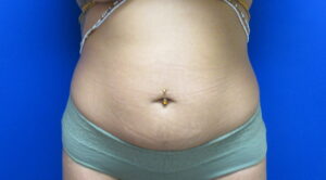 Before Image: Liposuction Patient 20