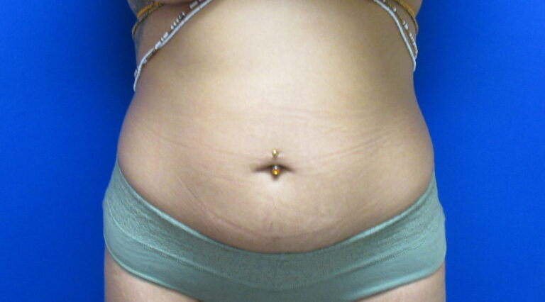 Before Image: Liposuction Patient 20 - front