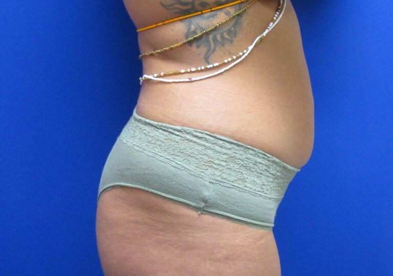Before Image: Liposuction Patient 20 - right-side