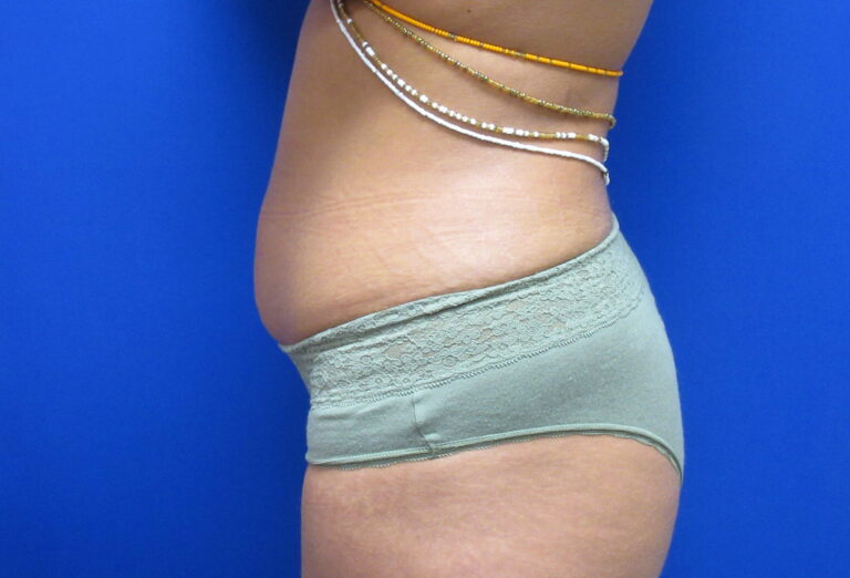 Before Image: Liposuction Patient 20 - left-side