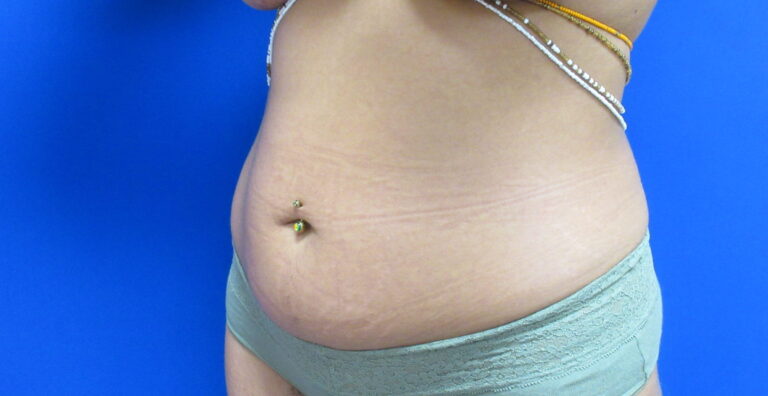 Before Image: Liposuction Patient 20 - left-front-oblique