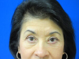 After Image: Blepharoplasty Patient 15