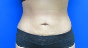 After Image: Liposuction Patient 20
