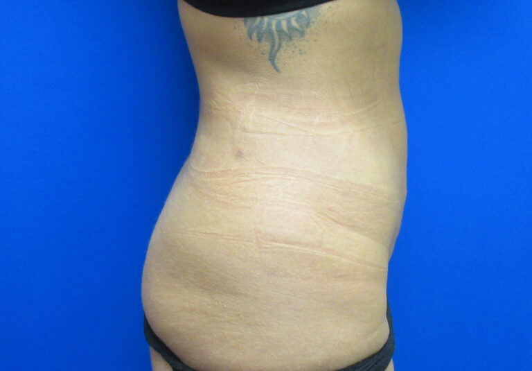 After Image: Liposuction Patient 20 - right-side