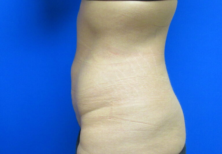 After Image: Liposuction Patient 20 - left-side