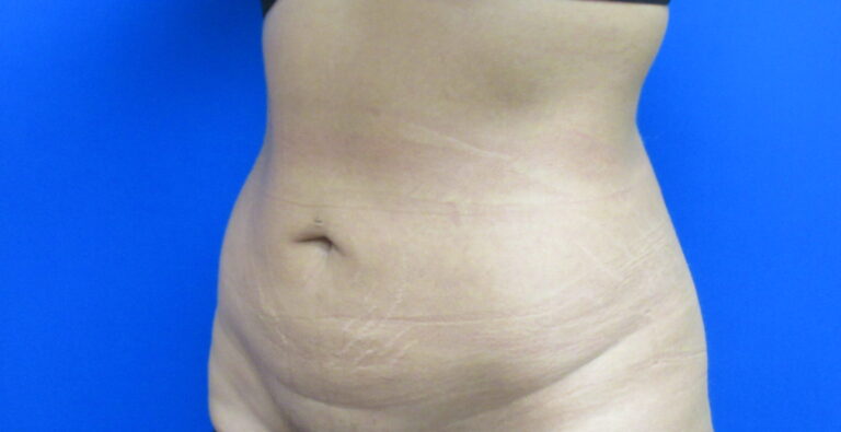 After Image: Liposuction Patient 20 - left-front-oblique