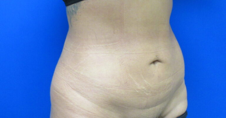 After Image: Liposuction Patient 20 - right-front-oblique