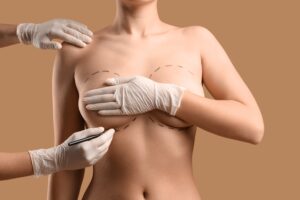 Woman's breasts covered by her arms as a surgeon marks on her for breast implant replacement surgery