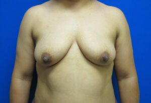 Before Image: Breast Augmentation with Lift Patient 28