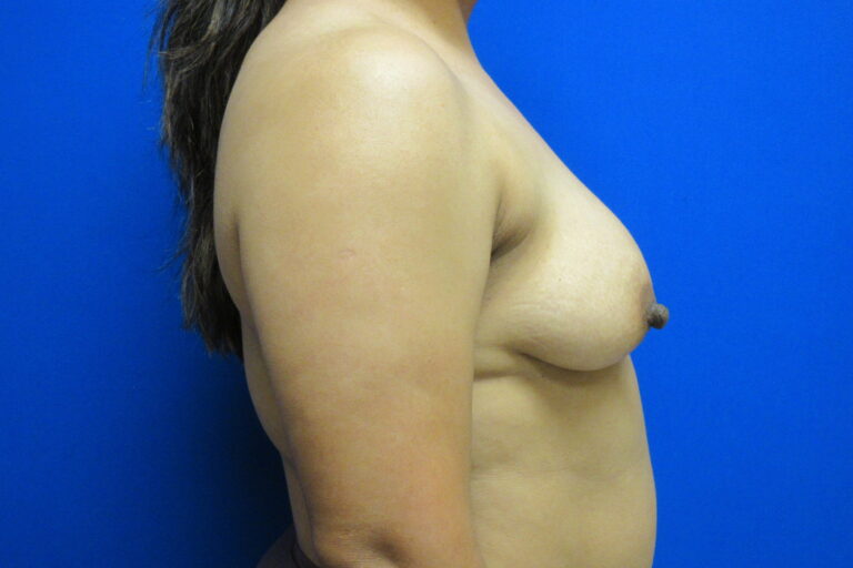 Before Image: Breast Augmentation with Lift Patient 28 - right-side