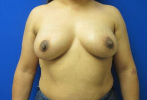After Image: Breast Augmentation with Lift Patient 28