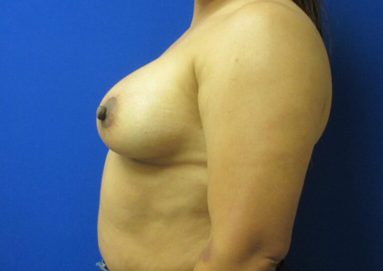 After Image: Breast Augmentation with Lift Patient 28 - left-side
