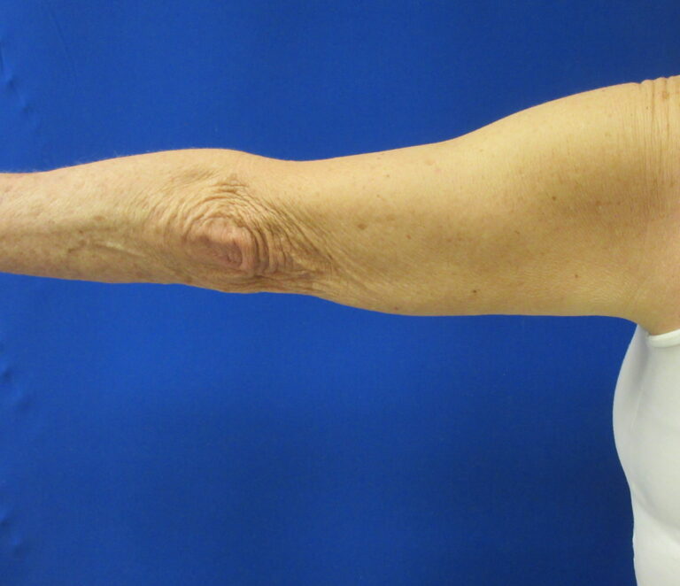 Before Image: Arm Lift / Brachioplasty Patient 12 - back