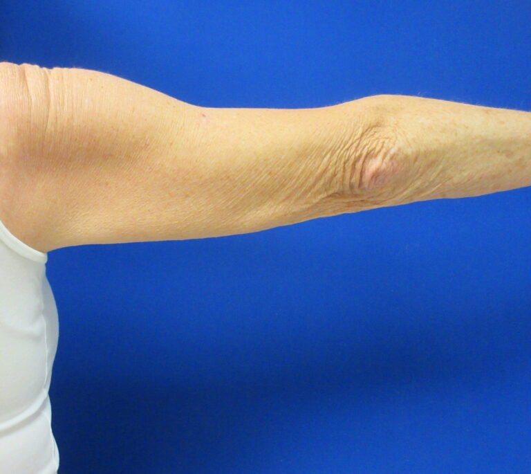 Before Image: Arm Lift / Brachioplasty Patient 12 - back