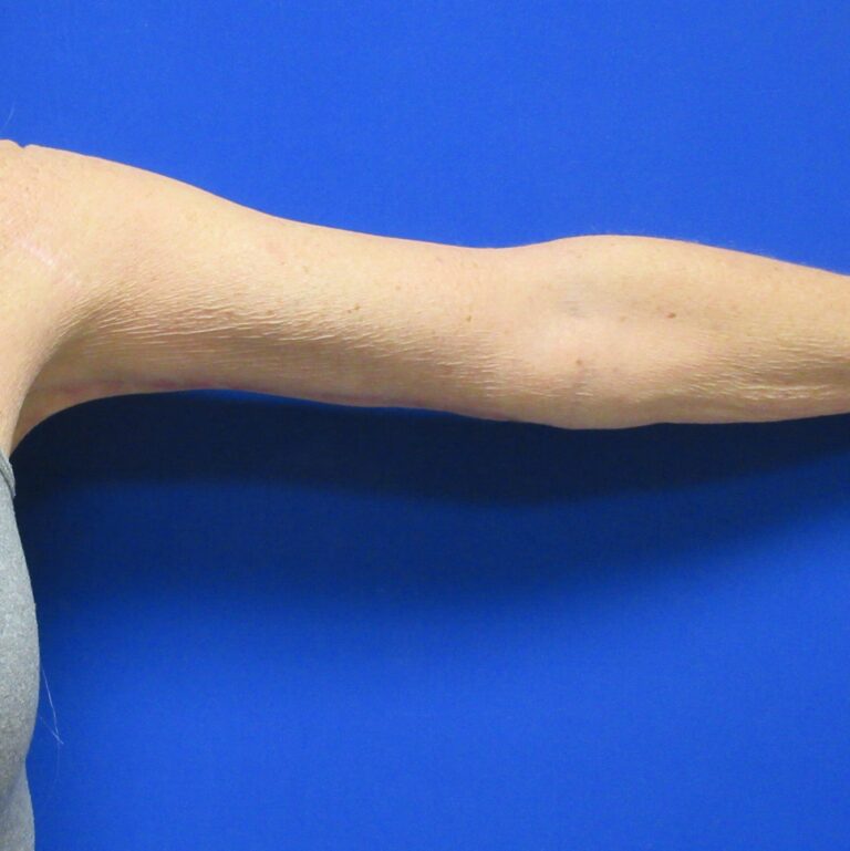 After Image: Arm Lift / Brachioplasty Patient 12 - front