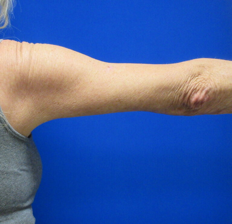 After Image: Arm Lift / Brachioplasty Patient 12 - back