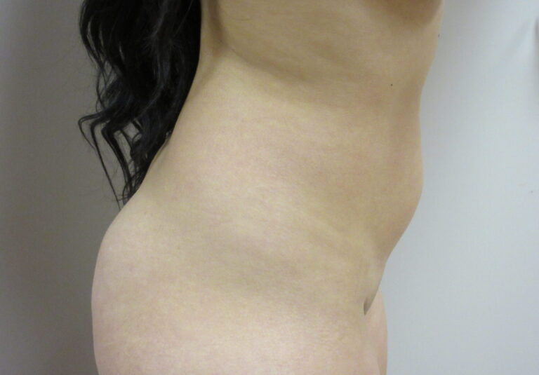 Before Image: Liposuction Patient 21 - right-side