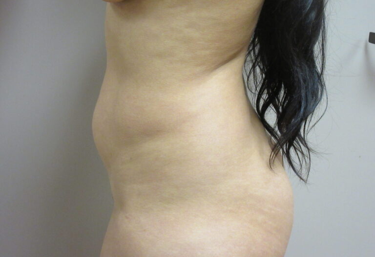 Before Image: Liposuction Patient 21 - left-side