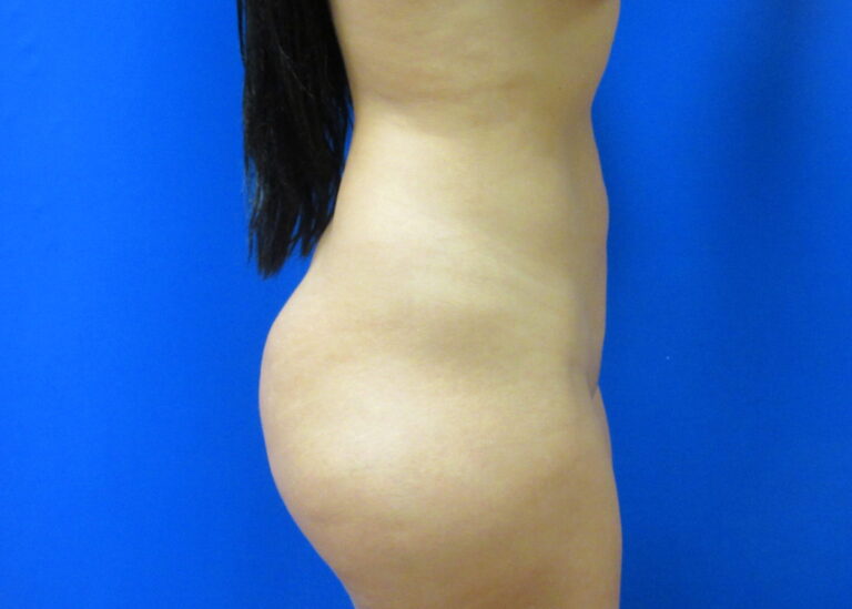 After Image: Liposuction Patient 21 - right-side