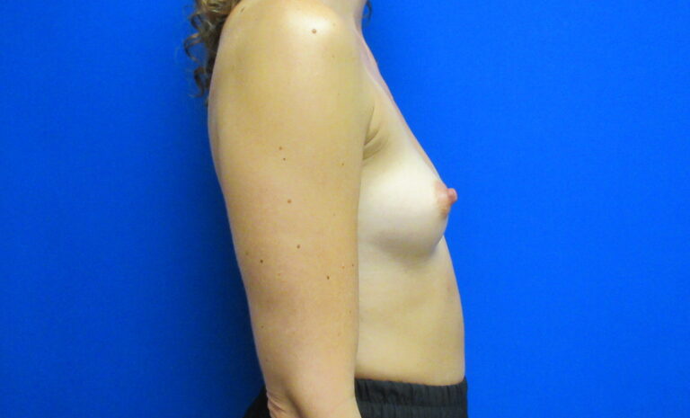 Before Image: Breast Augmentation Patient 169 - right-side