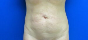Before Image: Tummy Tuck Patient 62