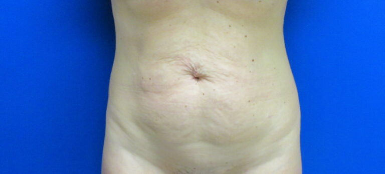 Before Image: Tummy Tuck Patient 62 - front