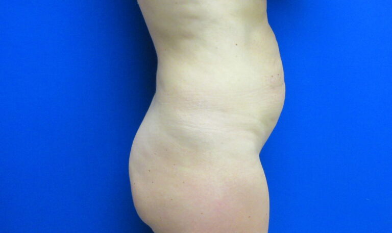 Before Image: Tummy Tuck Patient 62 - right-side