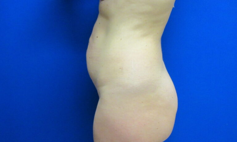 Before Image: Tummy Tuck Patient 62 - left-side