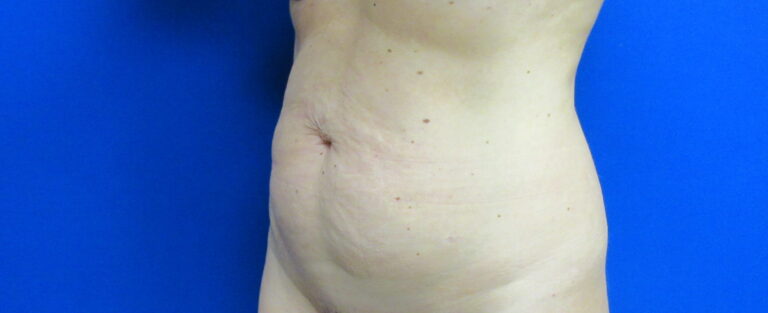 Before Image: Tummy Tuck Patient 62 - left-front-oblique