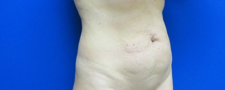 Before Image: Tummy Tuck Patient 62 - right-front-oblique