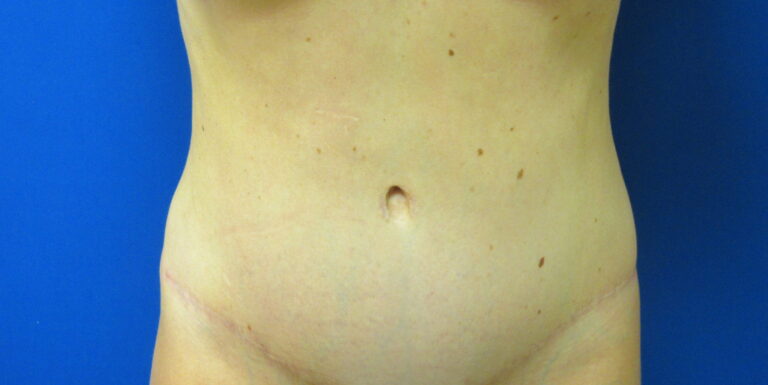 After Image: Tummy Tuck Patient 62 - front