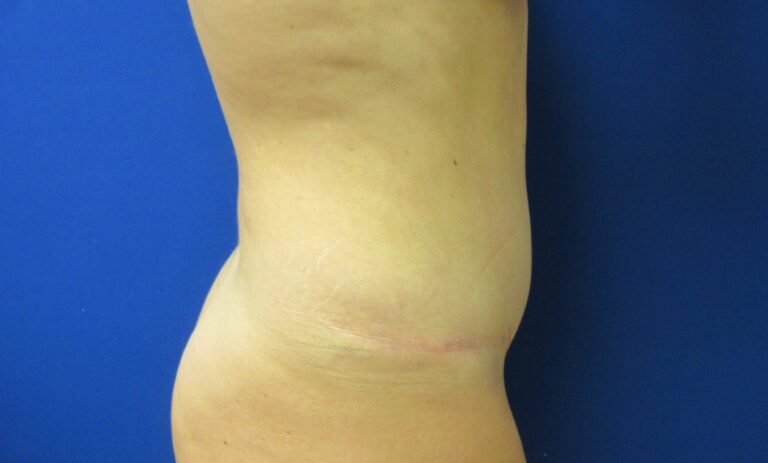 After Image: Tummy Tuck Patient 62 - right-side
