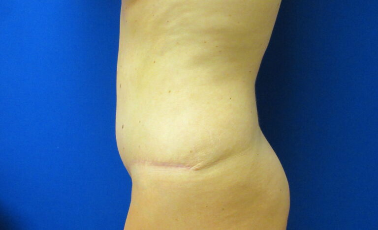 After Image: Tummy Tuck Patient 62 - left-side