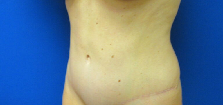 After Image: Tummy Tuck Patient 62 - left-front-oblique