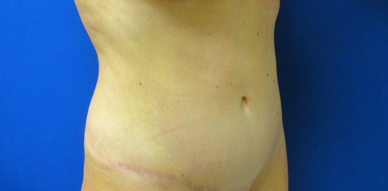 After Image: Tummy Tuck Patient 62 - right-front-oblique