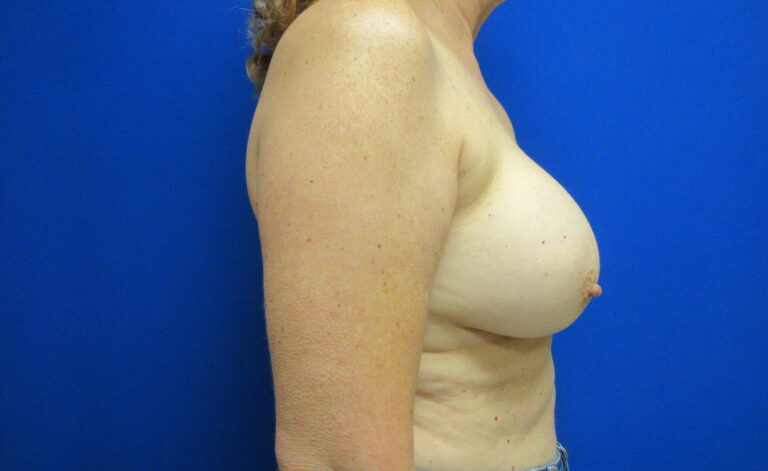 Before Image: Breast Implant Removal Patient 4 - right-side