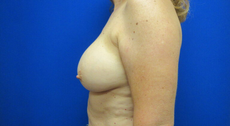 Before Image: Breast Implant Removal Patient 4 - left-side
