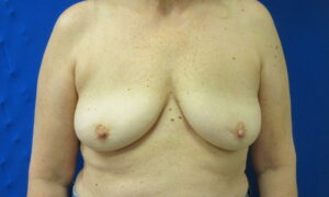 After Image: Breast Implant Removal Patient 4