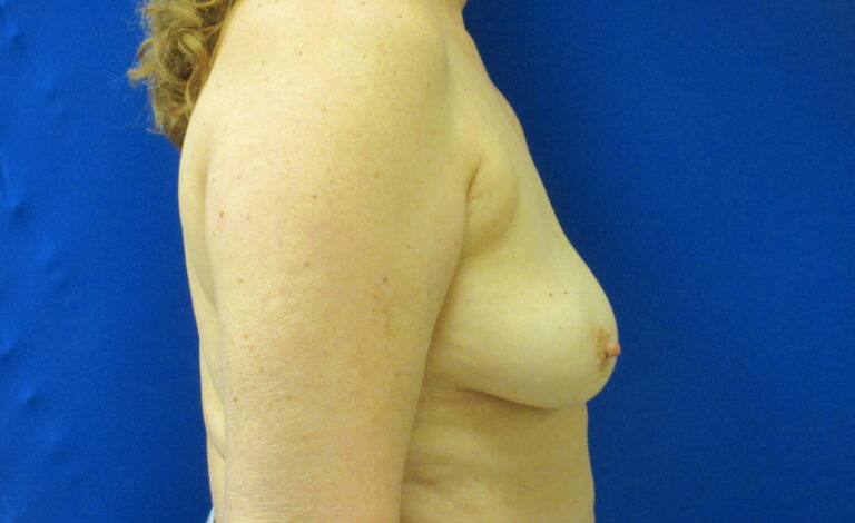 After Image: Breast Implant Removal Patient 4 - right-side