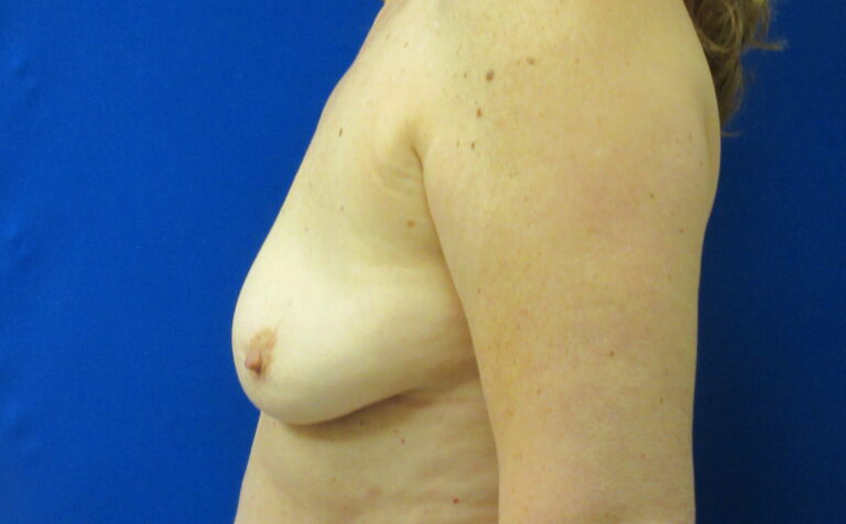 After Image: Breast Implant Removal Patient 4 - left-side