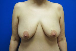 Before Image: Breast Augmentation with Lift Patient 29