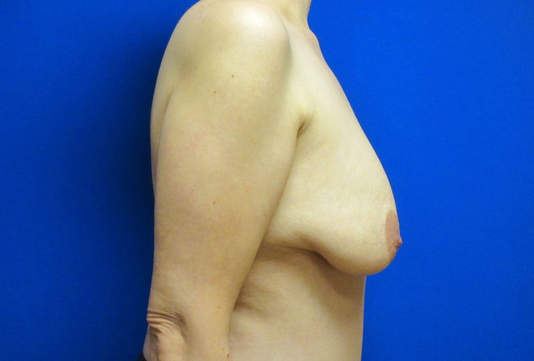 Before Image: Breast Augmentation with Lift Patient 29 - right-side