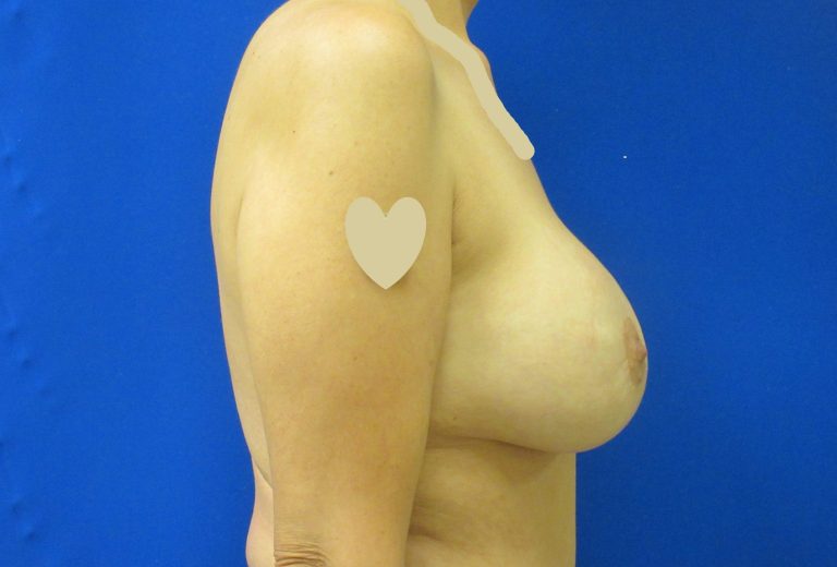After Image: Breast Augmentation with Lift Patient 29 - right-side