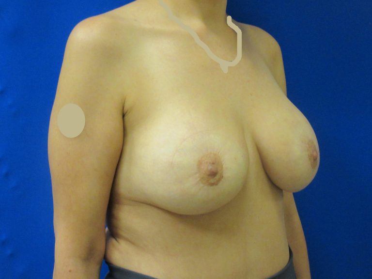 After Image: Breast Augmentation with Lift Patient 29 - right-front-oblique