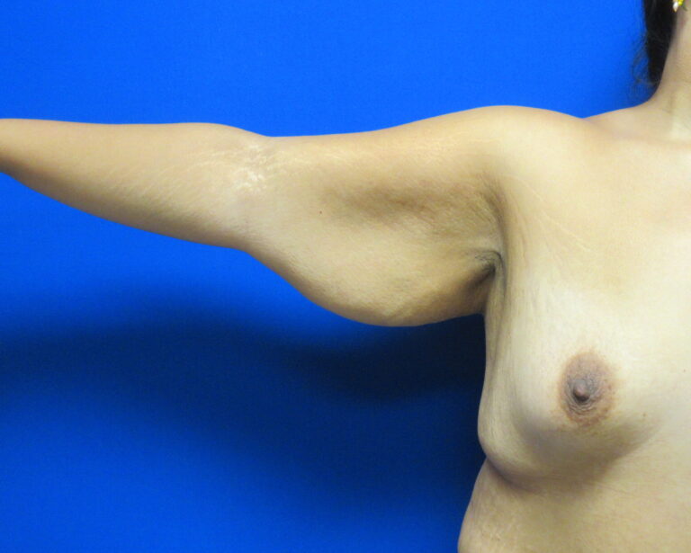 Before Image: Arm Lift / Brachioplasty Patient 13 - front