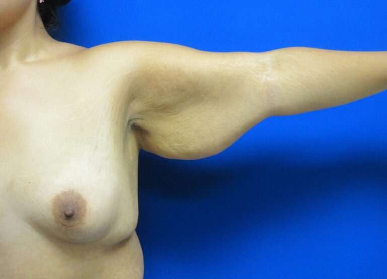 Before Image: Arm Lift / Brachioplasty Patient 13 - front