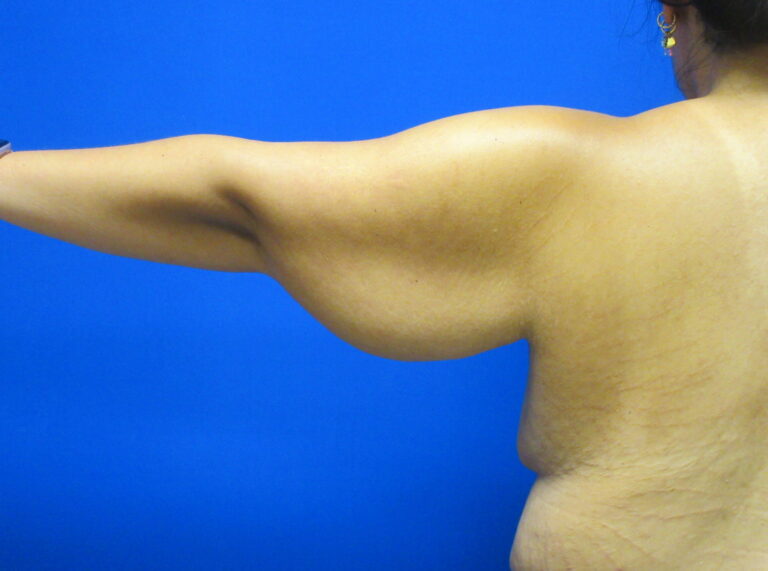 Before Image: Arm Lift / Brachioplasty Patient 13 - back