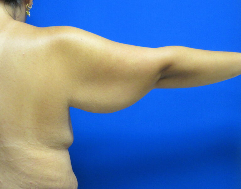 Before Image: Arm Lift / Brachioplasty Patient 13 - back