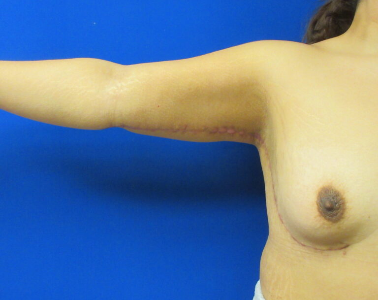 After Image: Arm Lift / Brachioplasty Patient 13 - front