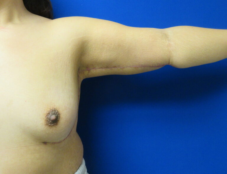 After Image: Arm Lift / Brachioplasty Patient 13 - front